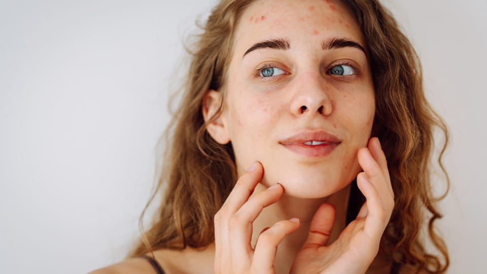 mladé dievča si prezerá akné na tvári